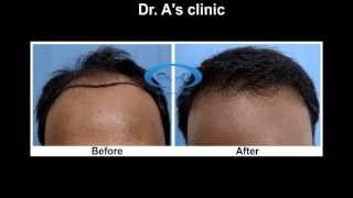 R54 - 4393 strip FUHT grafts (6 months update) Dr. A's Clinic