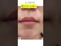 【皮膚科体験】ぷにゅぷにゅでボリューム感のある唇に💋┃ブラウン皮膚科┃#美容 #整形ビフォーアフター #韓国整形 #韓国 #ビフォーアフター #スキンケア #唇 #ヒアルロン酸 #ヒアルロン酸注射