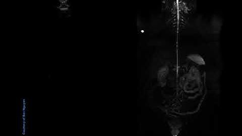 Whole Body DWI (wbDWI) @ Siemens 1.5T Aera vs. 3T Skyra