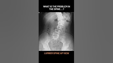 Lumber Spine AP View #spine #xray  #bones #anatomy #explore #explorepage #shorts #viral #edit #reel