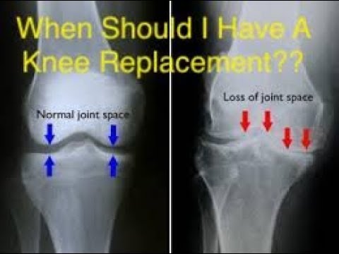 Do I Need A Knee Replacement