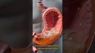 How Stomach Acid Starts Destroying the Protective Lining #digestion #acidreflux #digestiveenzymes