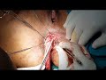 Delorme operation for fullthickness complete rectal prolapse