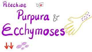 Petechiae, Purpura and Ecchymoses