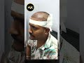 Ak Hair Transplant Results @Chennai, Velachery. Proof is in the progress! 🚀, Contact - 72000 99924.
