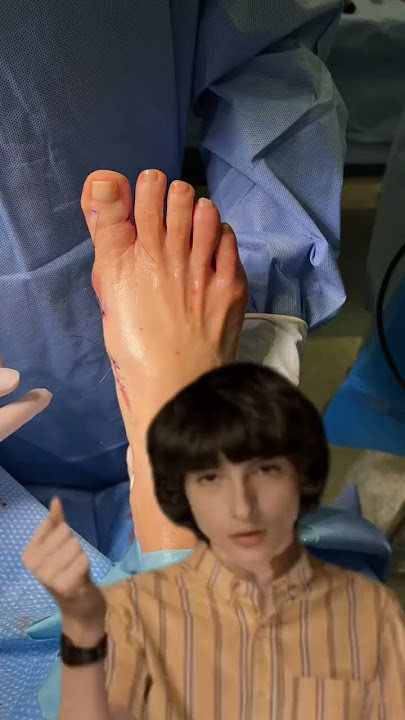 #minimallyinvasivesurgery #sportsmedicine #bunions #podiatrist #surgery