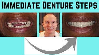 Steps in making immediate dentures