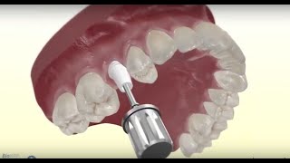 Video Procedura Implant Dentar - Inserare Implant Coroana Dentara Intr-O Zi