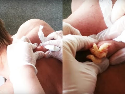 HUGE CYSTIC ACNE EXTRACTION #