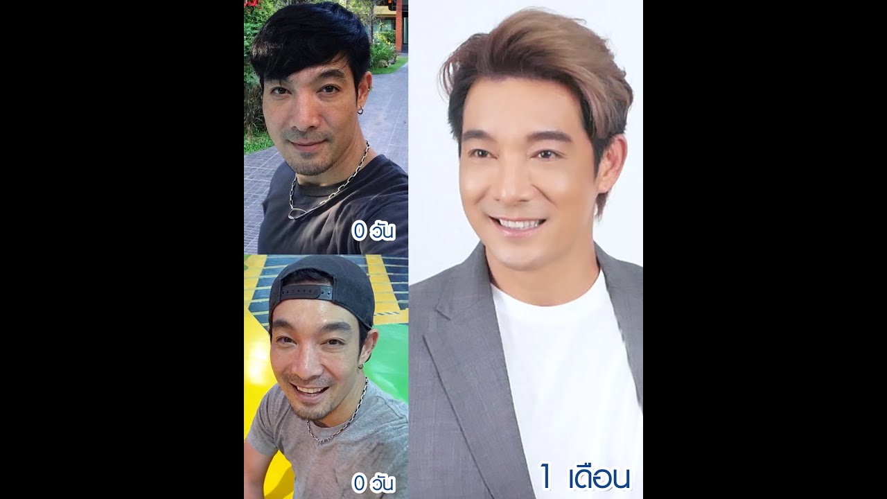 คุณโอ๊ต วรวุฒิ ผ่าตัดถุงไขมันใต้ตาที่  𝐖 𝐇𝐨𝐬𝐩𝐢𝐭𝐚𝐥 ‼ “หน้าดูสดใสขึ้น รอยแผลแทบมองไม่เห็น