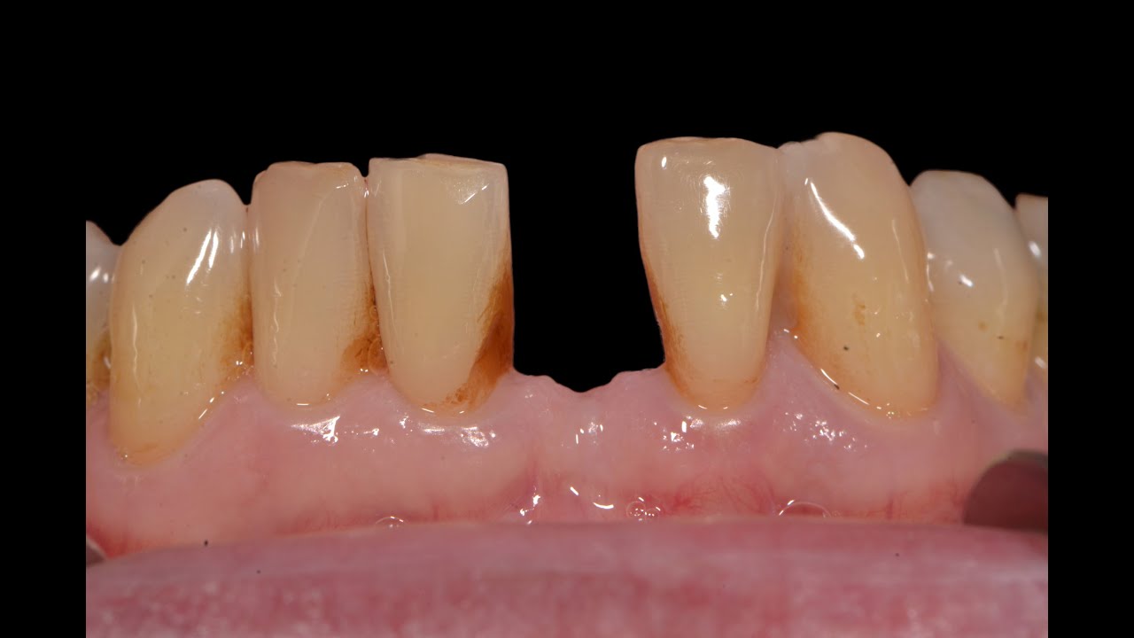 Lower Dental Implant Tooth Insertion | Implant Specialiast Team | Milton, Oakville, Burlington