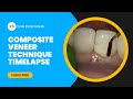 Composite veneer technique timelapse  dental online training