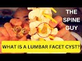 What is a Lumbar Facet Cyst?