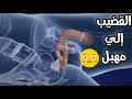 شاهد عملية تحويل العضو الذكري ل عضو أنثوي جراحه تحول الرجل لامرأه Surgery To Convert Pains To Vagina 