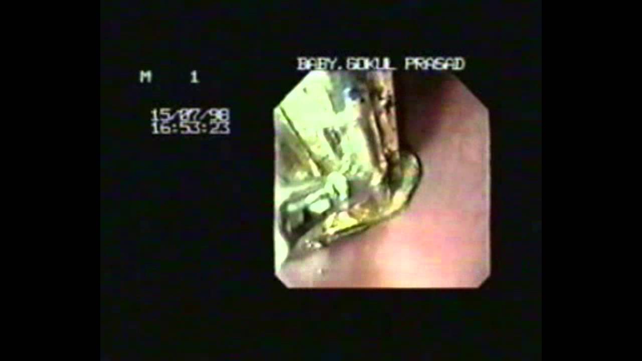 Endoscopic Foreign Body Removal YouTube