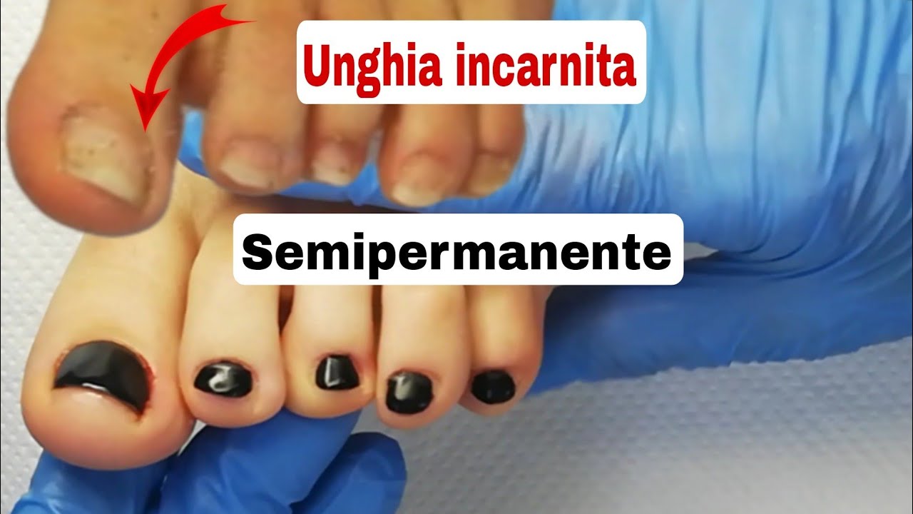 #Pedicure #unghie #incarnite #semipermanente