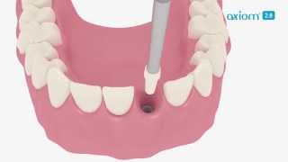 Anthogyr-Axiom-implant-28-EN