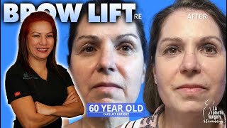 Brow Lift - Look Younger And Refreshed - Renuvion Minimally Invasive Results