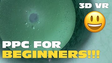 3D Phaco Clip #128 - Posterior Polar Cataract For Beginners (VR Headset Version)