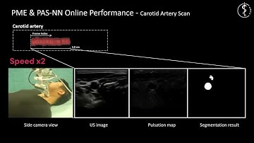 Motion Magnification in Robotic Sonography: Enabling Pulsation-Aware Artery Segmentation