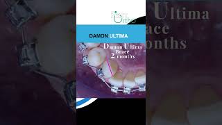 Damon Ultima Braces - Efficient and Effective #DamonUltima #Orthodontics #SmileTransformation