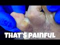 SHAVING OF EXTREMELY PAINFUL HIDDEN CALLUS