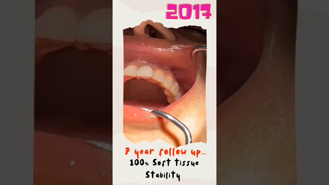 *TTPHIL ® ZERO BONE LOSS IN TILTED IMPLANTS WITH 100% SOFT TISSUE STABILITY! 7 YEAR FOLLOW UP*