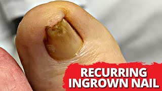 DEEP Ingrown Nail Removal On Recurring Ingrown Nail!