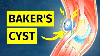 How to ACTUALLY Treat a Baker's Cyst (Pain Behind Knee)