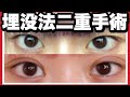 【埋没法】さよなら逆さまつ毛。遂に二重になりました。【二重手術】
