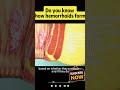 The Secret Life of Hemorrhoids 😱