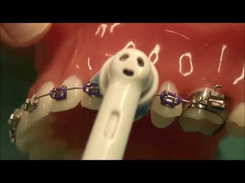 Video: Uuden Invisalign -lokeron asettaminen (kuvilla)