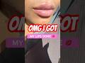 Baddie Activities #lipfiller #lipfillerinjections #lipfillerbeforeandafter #lips #injectablefillers