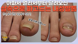 (ENG SUB) 유튜브를 보고 아픈 내성발톱을 가지고 멀리서부터 달려오신 고객님!/이젠 고통에서 안녕~/ingrown toenail/Athlete&#39;s foot-Fresh Foot