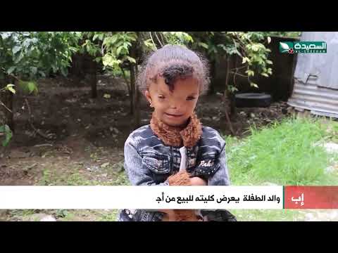 طفلة تتعرض للتنمر في المدرسة تجبر أب عرض كليته للبيع من أجل علاج تشوه في وجهها