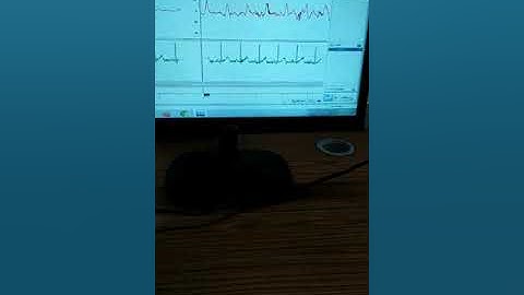 MEASUREMENT OF PULSE TRANSIT TIME