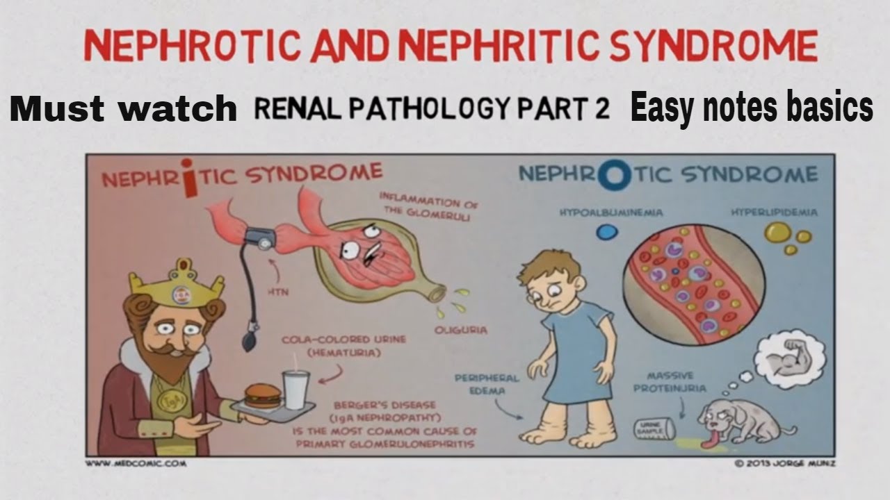 Causes Of Nephrotic Syndrome