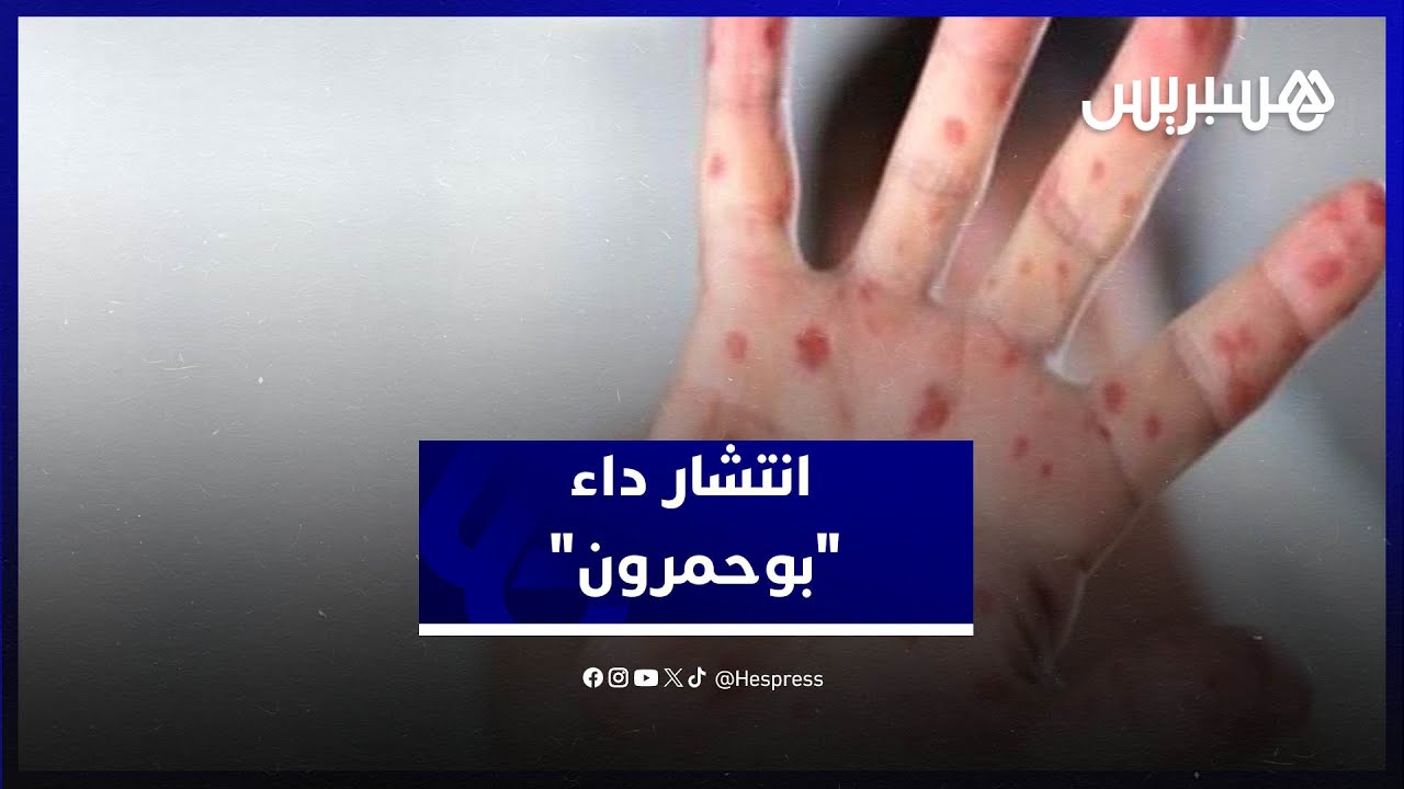 أخصائي في طب الأطفال يحذر من انتشار 