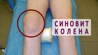 Синовит коленного сустава Синовит коленного сустава
