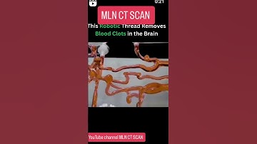 This Robotic Thread Removes Blood Clots in the Brain _#anatomy_#hospital_#ctscan_#_shorts_#_trending