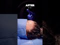 Forehead Reduction/ Alın Daraltma