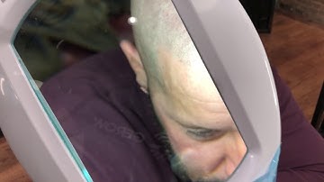 Magnifying ScalpMicropigmentation UP CLOSE!!