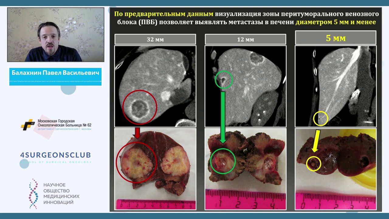 "Рак прямой кишки: яблоко раздора или зерна истины?" ЗАЛ 3. Метастатический колоректальный рак.