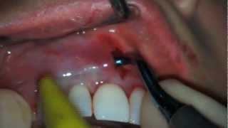 Treatment of Gum Recession by VISTA technique Case(II) screenshot 2