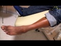 Tennis Ankle Injury Ozone Injection, Dr. Bino Rucker, M.D.