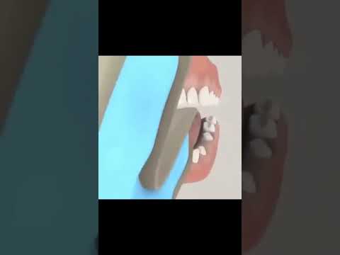 طريقة عمل جسر للأسنان