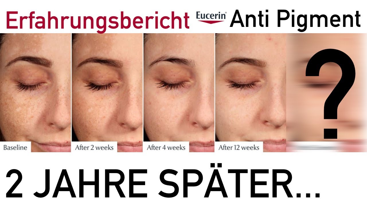 Pigmentflecken Update nach 2 Jahren Eucerin #AntiPigment | + Emotionale  Story Haut blutig weggeätzt - YouTube