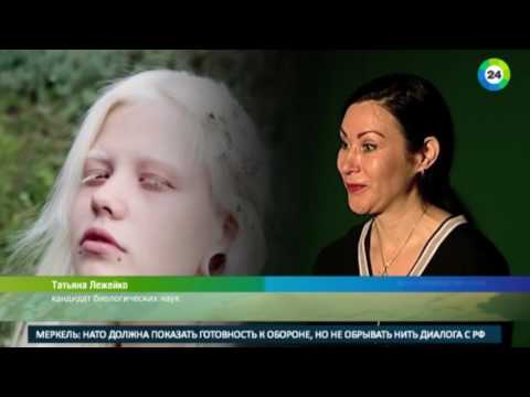 Альбиносы: белые вороны среди людей