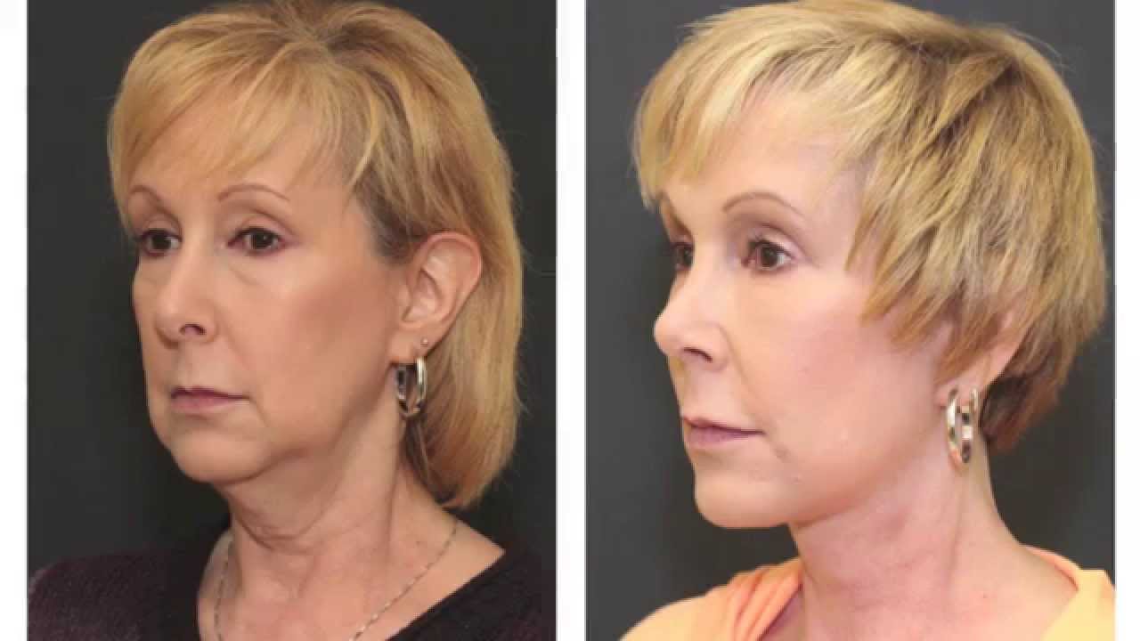 Facelift, Necklift,and Rhinoplasty Before and After | Dr. L. Mike Nayak St. Louis Reviews - YouTube