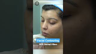Facial Contouring with Dermal Fillers #shorts #youtubeshorts